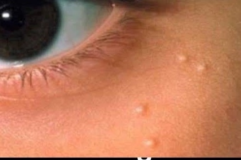 Yağ Bezesi (Lipom) Nasıl Geçer? 6 D’oğal Des tek