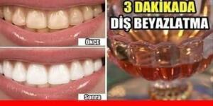 Diş taşının oluşmasının temel sebeplerinden biri