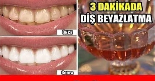 Diş taşının oluşmasının temel sebeplerinden biri