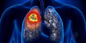 İş’te akciğer k’an serinin 12 belirtisi..