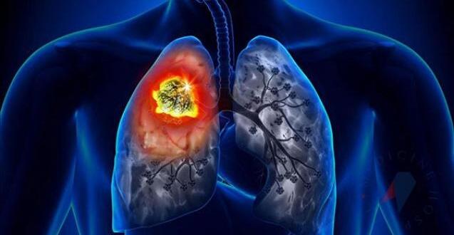 İş’te akciğer k’an serinin 12 belirtisi..