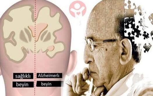 Alzheimer’a yakalanmamak için terk etmeniz gereken O 9 alışkanlık!!