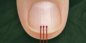 40 Yaşından Sonra Eğer Tırnağınızda Bu Çizgiler Varsa..