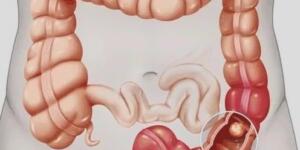 Kolon K-a’n serinin 5 Belirtisi