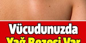 Vücudunuzda Yağ Bezesi Var Ise İş’te D’oğal T’edavisi